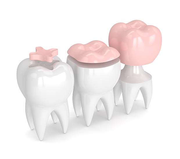 Santa Clara Dental Inlays and Onlays